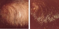 hair transplant