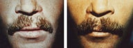 mustache hair transplant