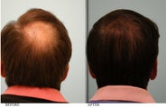 Hair Transplant to crown