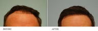 Hair Transplant