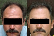 NeoGraft hair transplant
