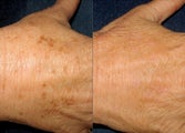 IPL Photofacial Hand Rejuvenation