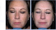 Limelight Ipl Treatment of the face
