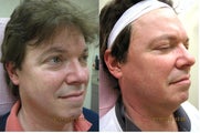 Intense pulsed light (IPL)