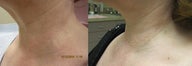 Intense pulsed light (IPL)
