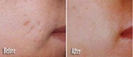 IPL for Acne Scar Treatment Before and After