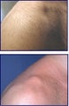 IPL for Age Spot and Hair Removal Before and After
