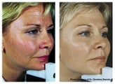 IPL for Age Spots