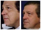IPL for Age Spots and Freckles