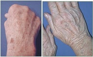 IPL for Age Spots and Freckles