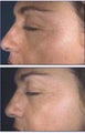 IPL for Freckles and Age Spots