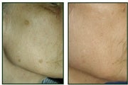 IPL for Age Spots, Hyperpigmentation