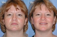 IPL for Freckles, Age Spots on Chest