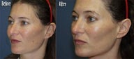IPL for Age Spots