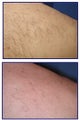 IPL for hyperpigmenation, age spots and skin tone