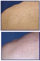IPL for hyperpigmenation, age spots and skin tone