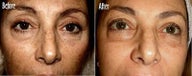 IPL for Freckles and Age Spots