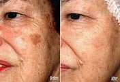 IPL for Age Spots, Hyperpigmentation
