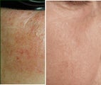 IPL for Age Spots