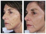 IPL for hyperpigmenation, age spots and skin tone