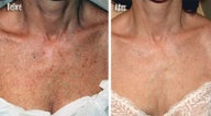 IPL for Freckles, Age Spots on Chest