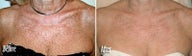 IPL for Age Spots and Uneven Skin Tone on Chest