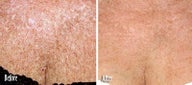 IPL for Age Spots and Uneven Skin Tone on Chest
