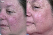 IPL for Spider Veins and Uneven Skin Texture