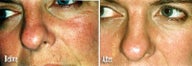 IPL for Rosacea, Hyperpigmentation and Spider Veins