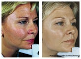 IPL to face to even skin tone