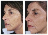 IPL to full face for uneven skin tone