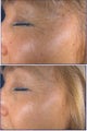 IPL to sundamaged skin