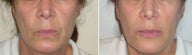 Lower Face Filler