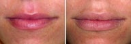 Lip Volumizing