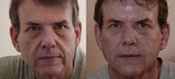 Dermal filler facial transformation