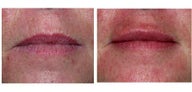 Lip rejuvenation
