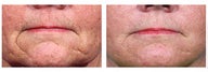 Restylane to wrinkles around mouth