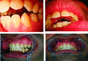 Invisalign
