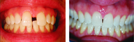 Closing large midline diastema/gap