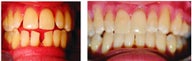 Multiple gaps closed with Invisalign