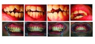 Treatment of anterior open bite with Invisalign