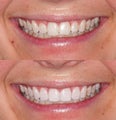 Invisalign with tissue corrections & whitening