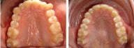 Invisalign treatment for crowded teeth