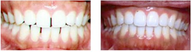 Invisalign Gallery Before-After
