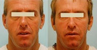 Injectable Fillers (Juvederm/Radiesse)