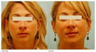 Injectable Fillers (Juvederm/Radiesse)