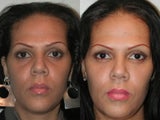 Eyelid troughs or hollows