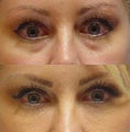Juvederm injection in the tear troughs