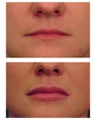 Juvederm