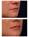 Juvederm